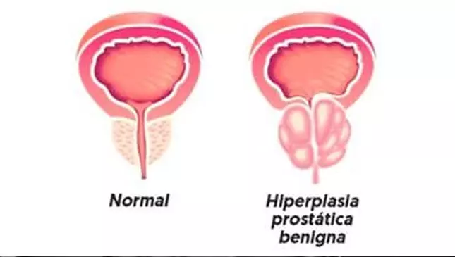 diferença entre próstata aumentada e normal