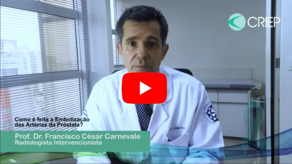 Dr Carnevale responde sobre embolização da próstata