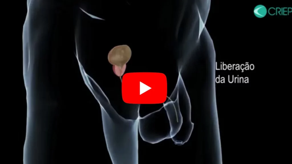 explicação da Técnica de embolização da próstata